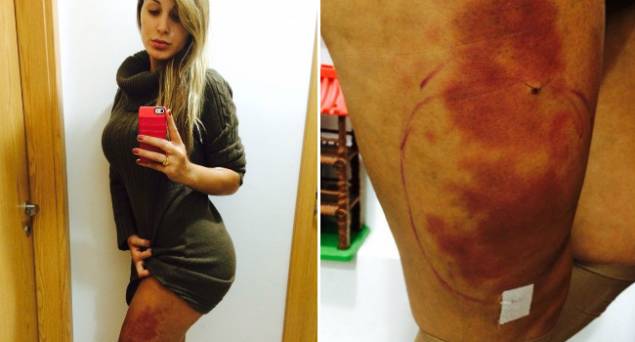 Nas redes sociais, Andressa exibiu edema nas pernas, em decorrência da aplicação do hidrogel