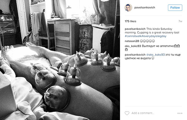 O que são as marcas nas costas do nadador Michael Phelps?