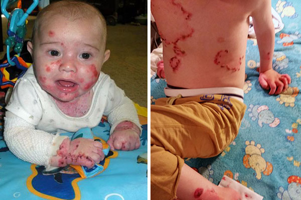 Menino de 5 anos sofre com rara doença genética que provoca bolhas e graves ferimentos na pele