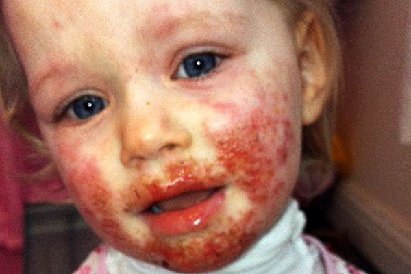 Rosto De Menina De 3 Anos E Comido Vivo Por Virus Da Herpes Veja Sao Paulo