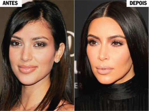 A socialite Kim Kardashian, antes e depois, da bichectomia. (Foto: Reprodução.)