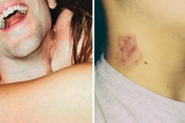 Adolescente de 17 anos de idade morre após receber “chupão” da namorada