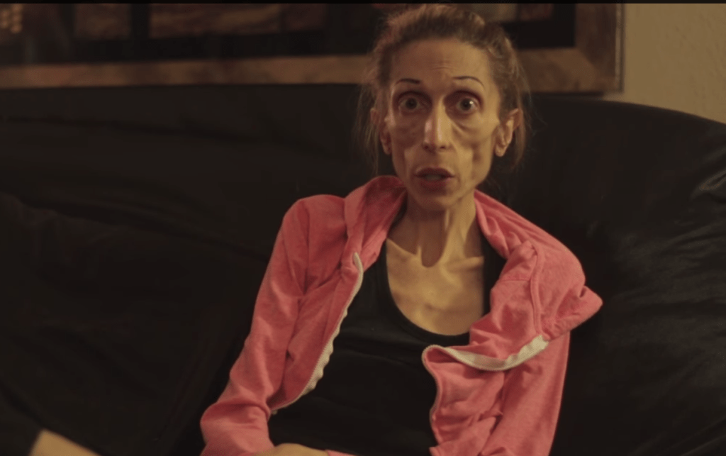 anorexia2