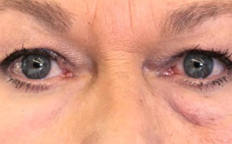 creme-antes-depois-rugas