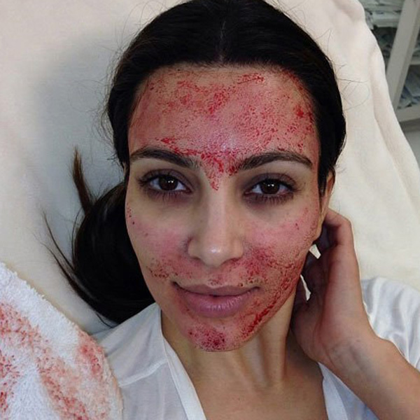 kim-kardashian-vampire-facial-expert-lead-1