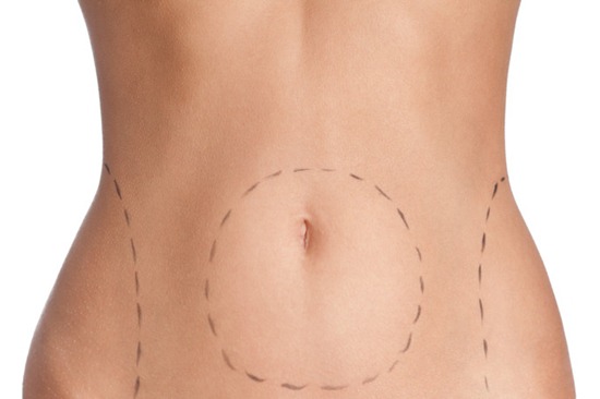 Vai encarar uma lipo? Confira cinco respostas para perguntas frequentes sobre a cirurgia