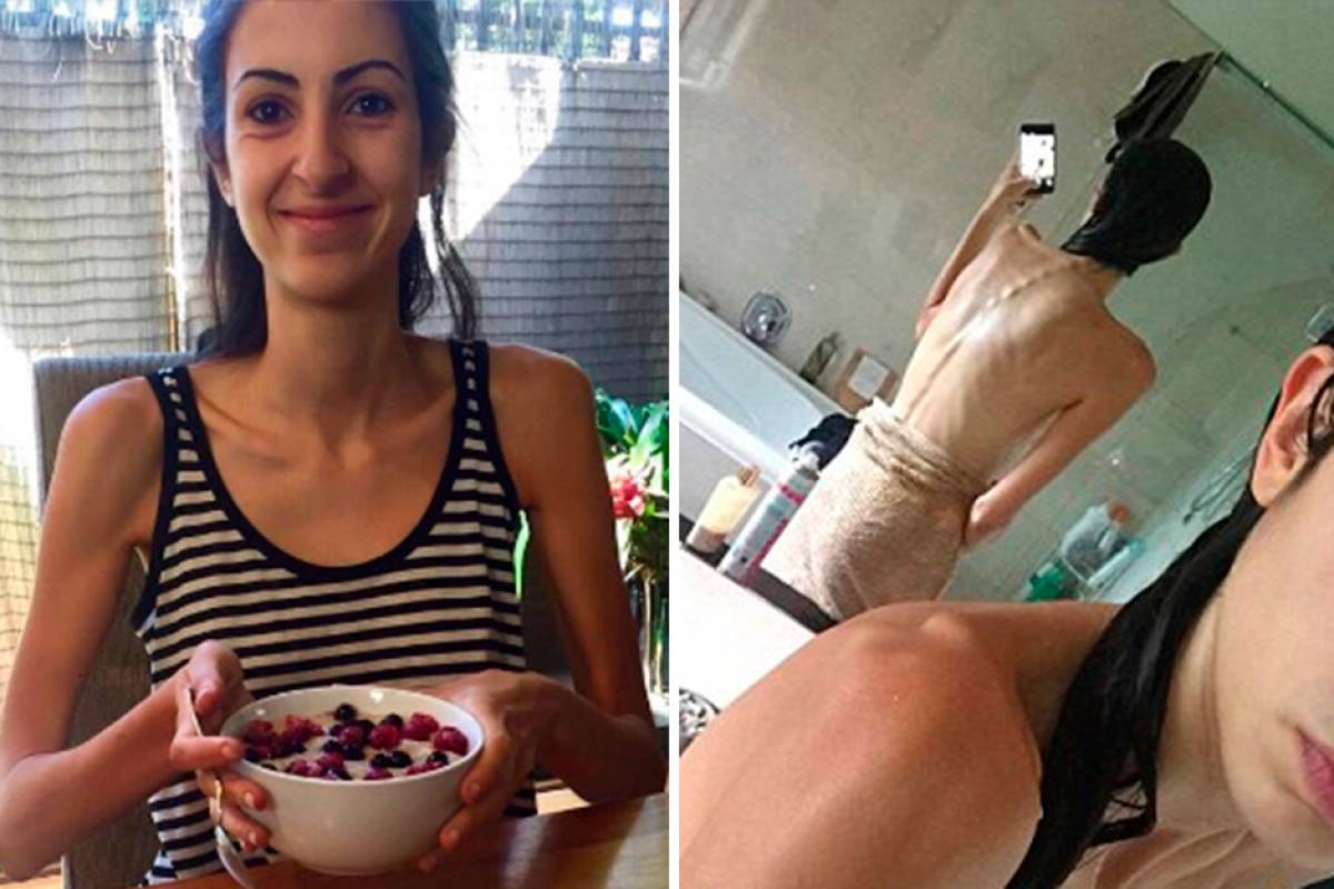 Anorexia: jovem que ficou uma semana sem comer vira vegana e conta