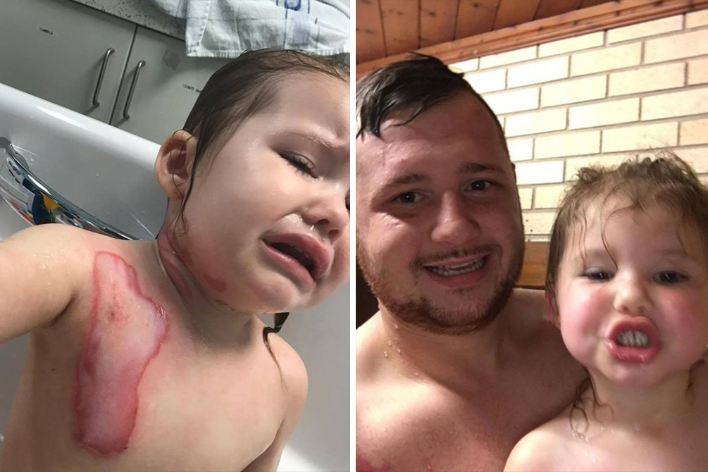 Pai faz tatuagem para ajudar filha que sofreu queimaduras