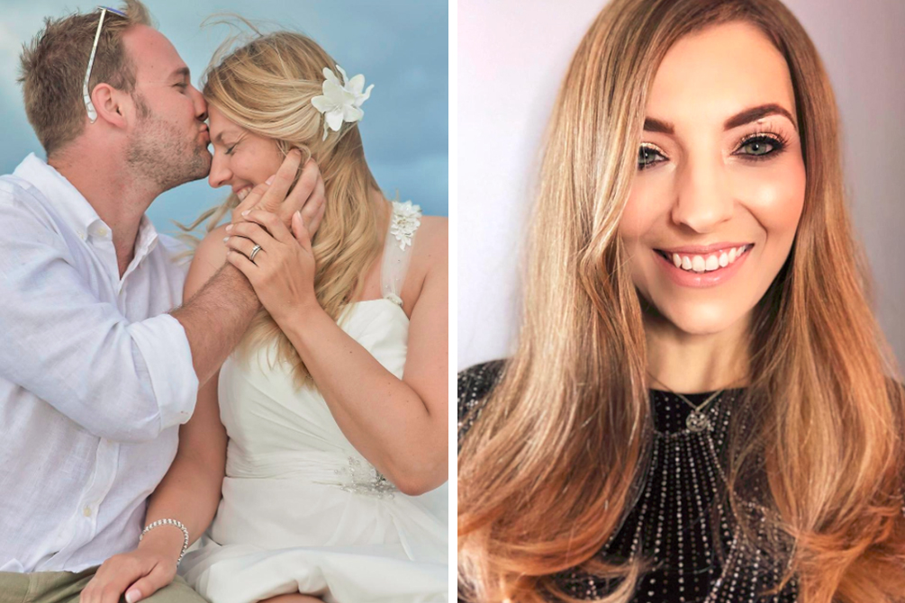 Noiva revela como perdeu 90% do cabelo após estresse com casamento