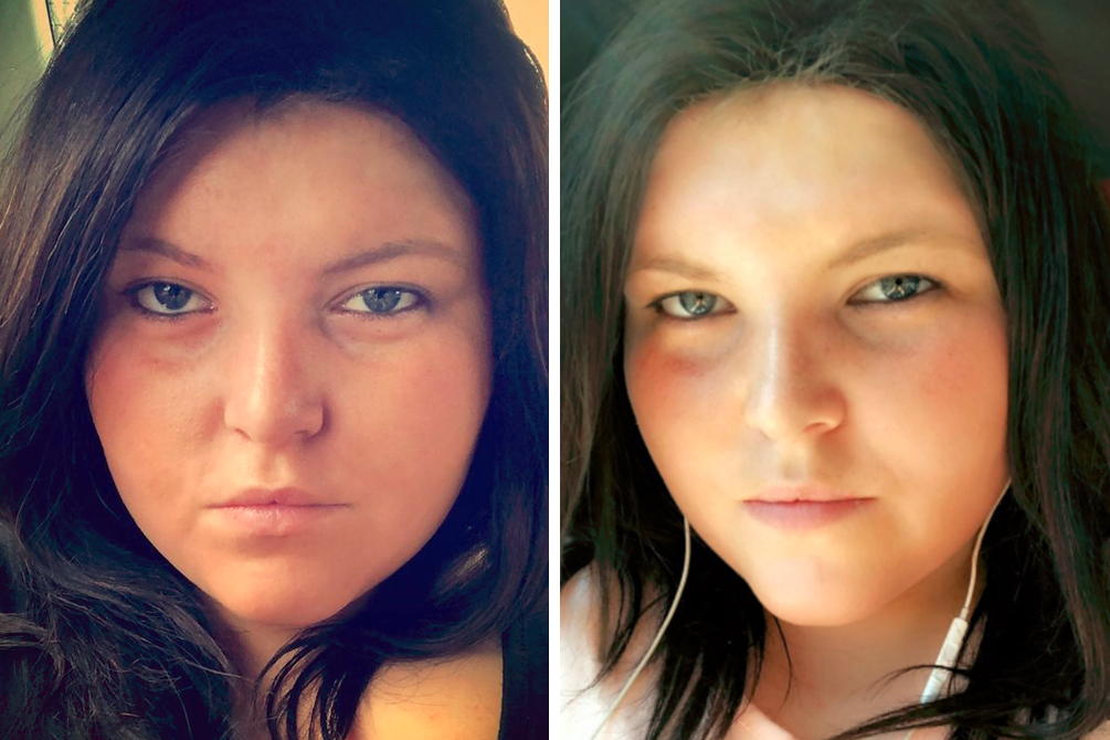 Jovem fica com cicatriz de 15cm após procedimento estético dar errado