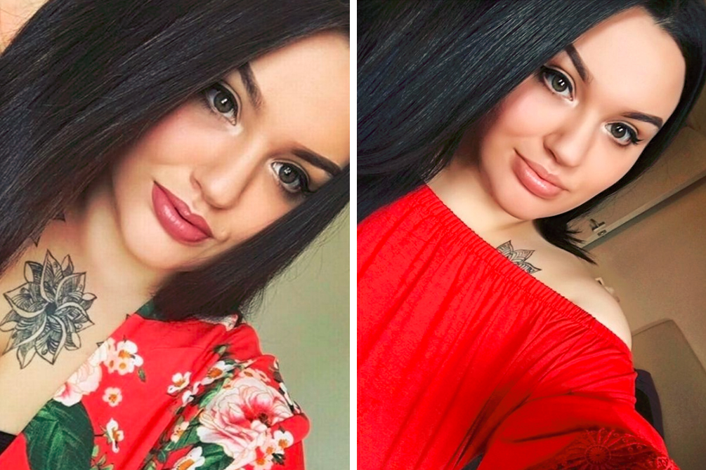 Mulher tem vergonha de sair de casa após procedimento estético