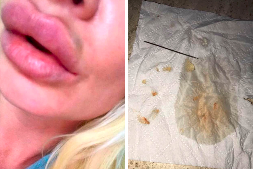 preenchimento-labial-04