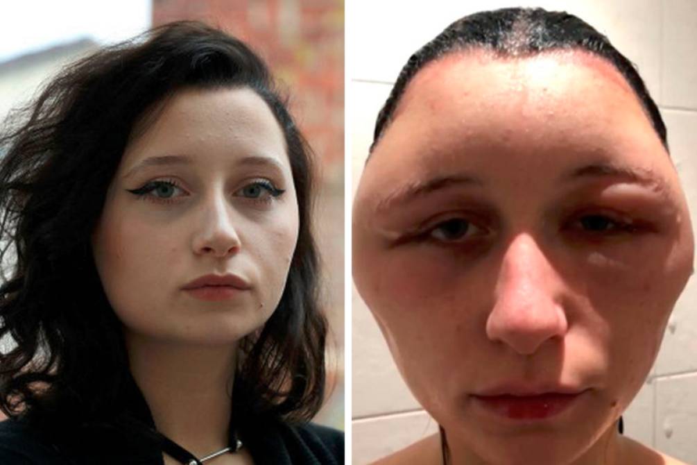 Após tubo de tintura para cabelo explodir adolescente fica cega