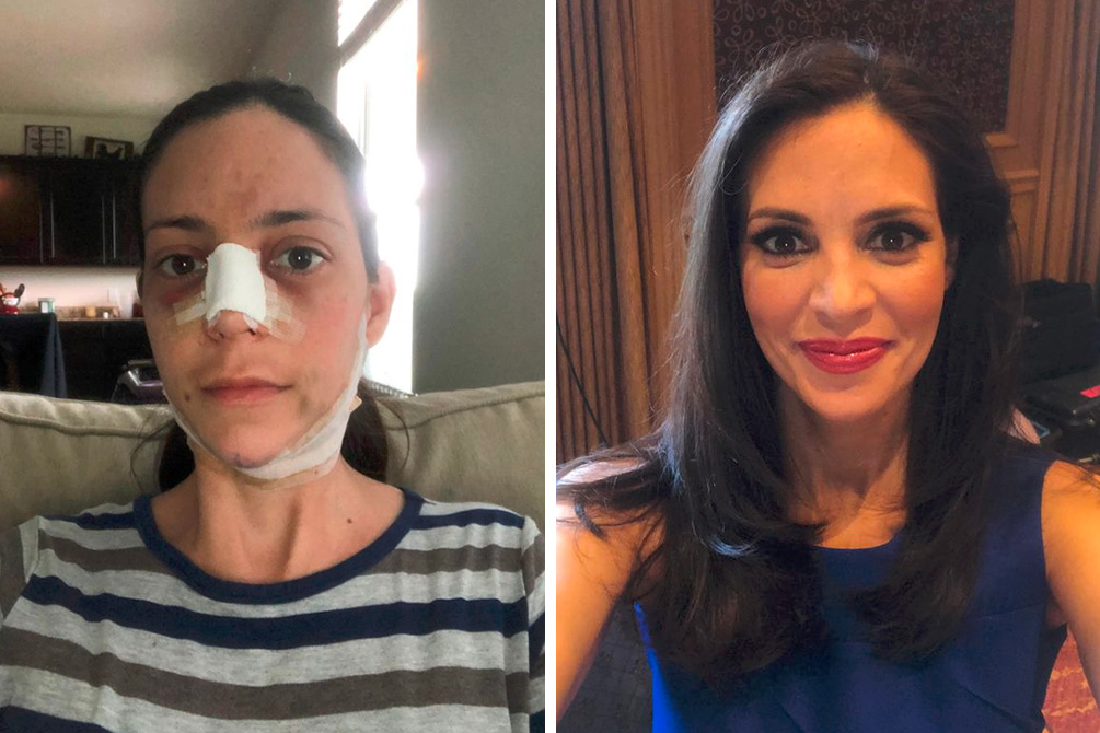 cirurgia-plastica-meghan-markle-04