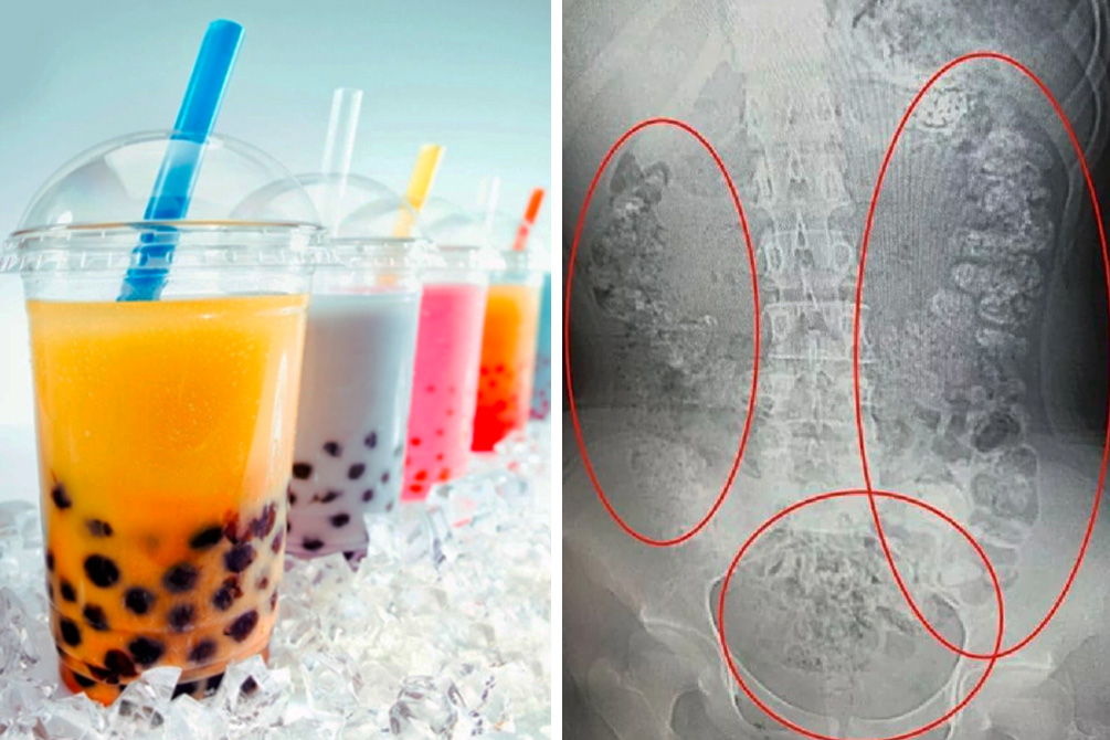 Jovem fã de bubble tea vai parar no hospital após consumir bebida
