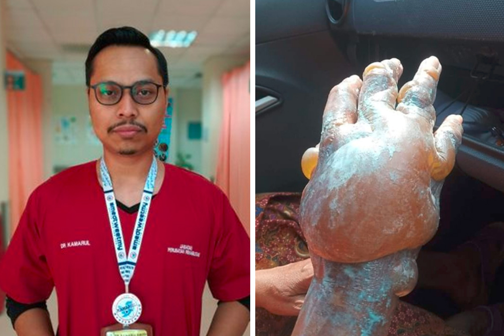 Médico faz alerta sobre popular remédio caseiro para queimaduras