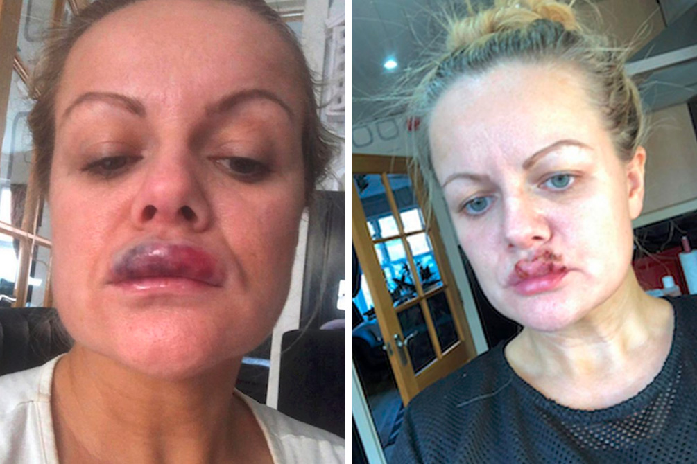 Mulher quase perde a visão após preenchimento labial que deu errado