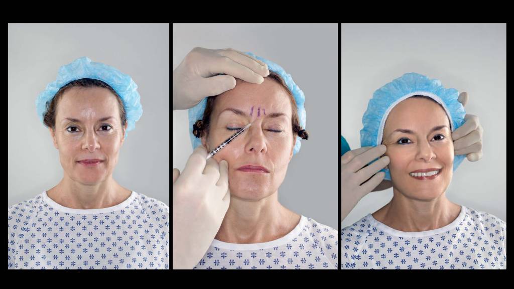 Triptych series of a woman receiving botox treatment, showing before, during and after the process Triptych series of a woman receiving botox treatment, showing before, during and after the process