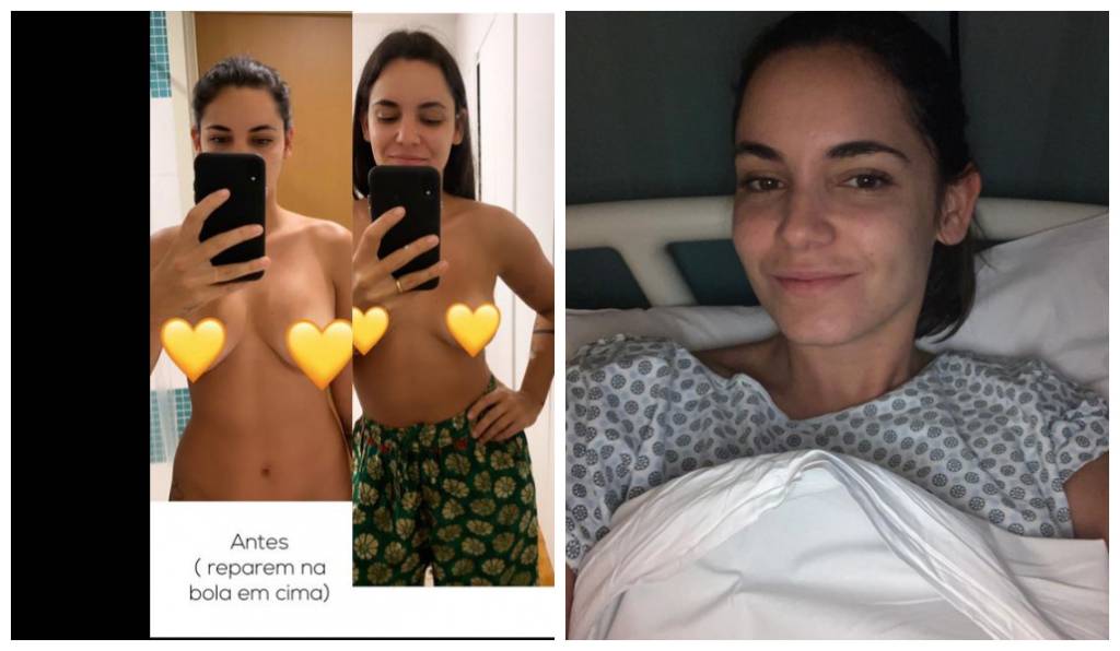 Renata Vanzetto: antes e depois do explante de silicone compartilhado nas redes sociais