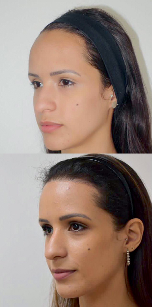 antes (acima) e depois (abaixo) de cirurgia de redução de testa na Renata Marques