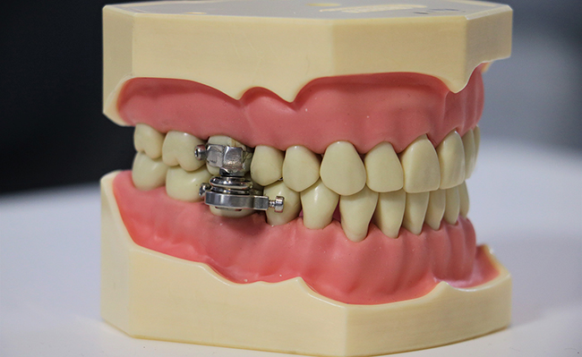 Imagem mostra foto de dentadura humana falsa, com dispositivo que aparece nos dentes molares superiores, impedindo a abertura da dentadura