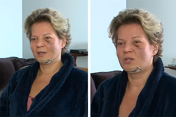 Joice Hasselmann sofre fraturas no rosto, coluna e quebra dentes | VEJA SÃO  PAULO