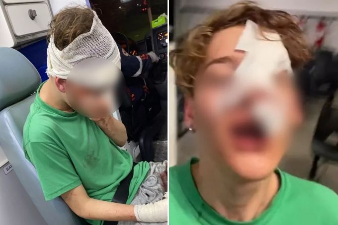 A montagem mostra duas fotos. À esquerda, um menino com a cara borrada sentado em uma ambulância e enfaixado da testa para cima. À imagem da direita, também borrada, mostra o menino tirando uma selfie mostrando os curativos no rosto.