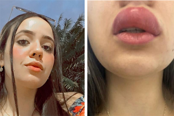 Montagem mostra, à esquerda, selfie de jovem de 21 anos em dia ensolarado; à direita, selfie de lábio inchado após picada de inseto