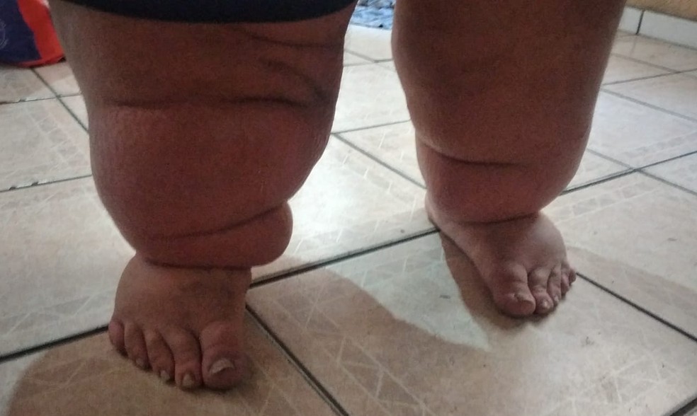 Imagem das pernas de Carlos, com excesso de peso