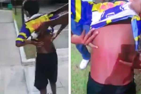 Montagem mostra duas fotos que exibem as costas da criança após a agressão, com marca pela cintada