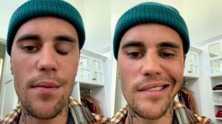 Justin Bieber surge com metade do rosto paralisado