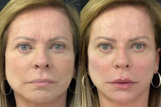 Cristina Rocha: antes e depois de harmonização facial
