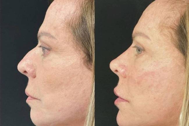 Cristina Rocha: antes e depois de harmonização facial