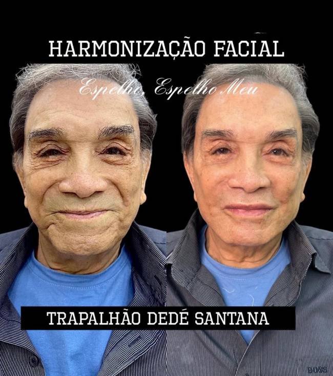 Antes e depois de harmonização facial de Dedé Santana