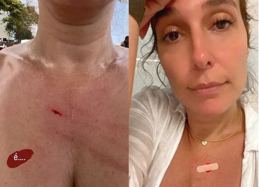 Nos stories do Instagram, Natasha mostrou o corte no peito resultado do assalto