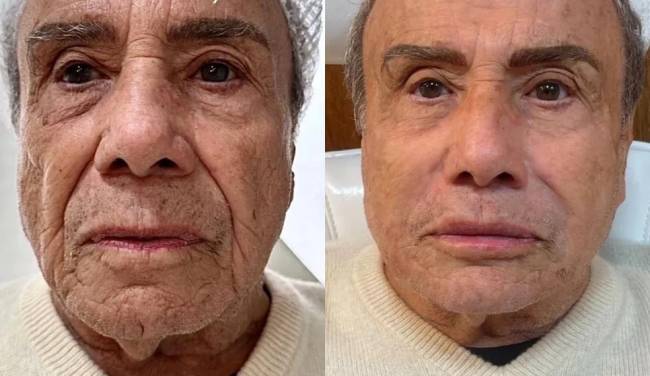 Antes e depois da harmonização facial de Stênio Garcia.