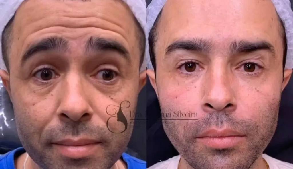 Motorista envolvido no acidente de Kayky Brito faz harmonização facial