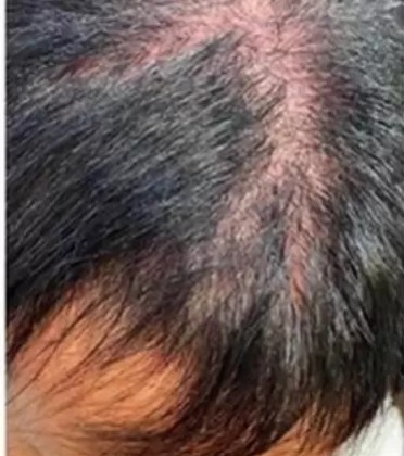 gretchen-cabelo-alopecia